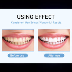 A Photo Of IVISMILE M6 Powerful Teeth Whitening Kit